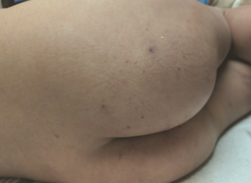 Figure 2: Gluteal rash on presentation.