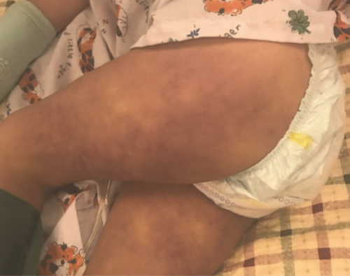 Figure 3: Bilateral lower extremity rash 3 hours after initial presentation. 