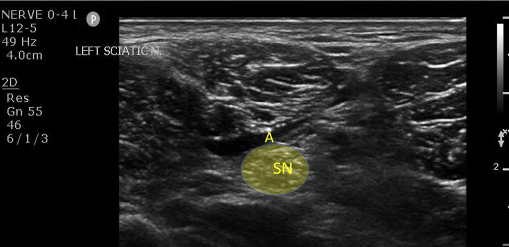 Popliteal Sciatic Nerve Block | EM Ultrasound Section