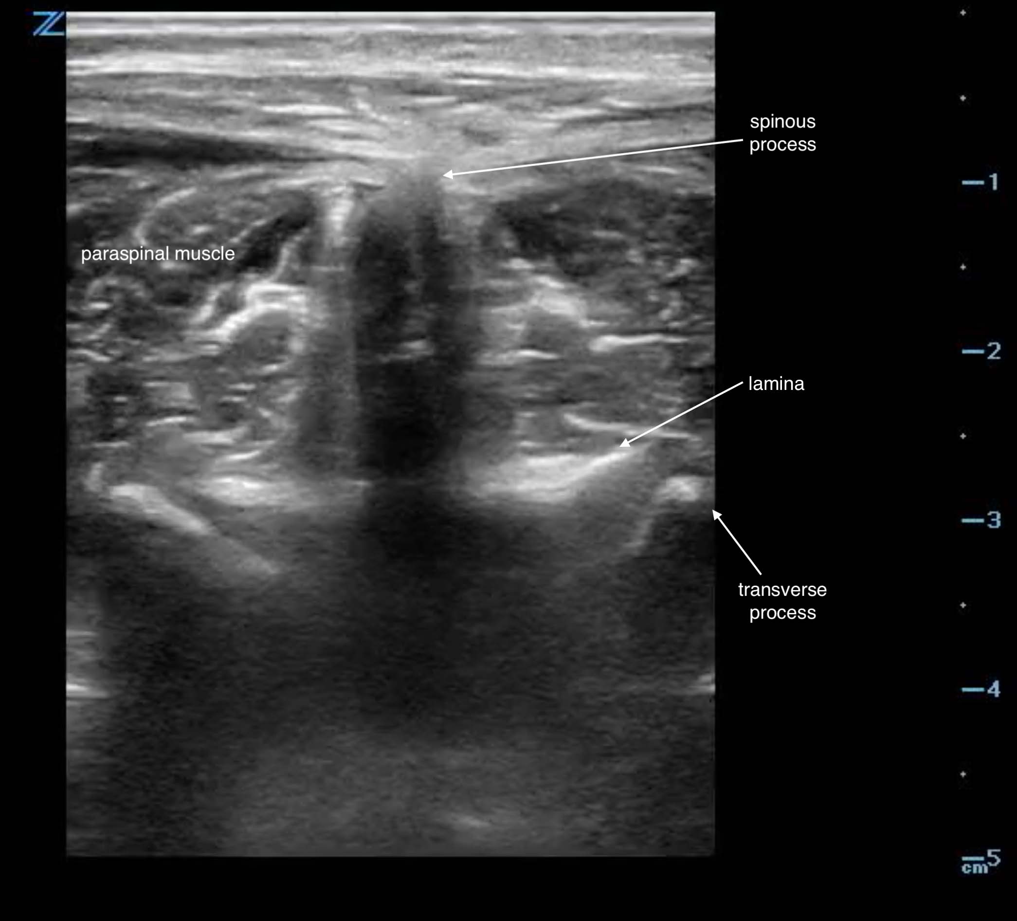 Sonoguide Lumbar Puncture 2850