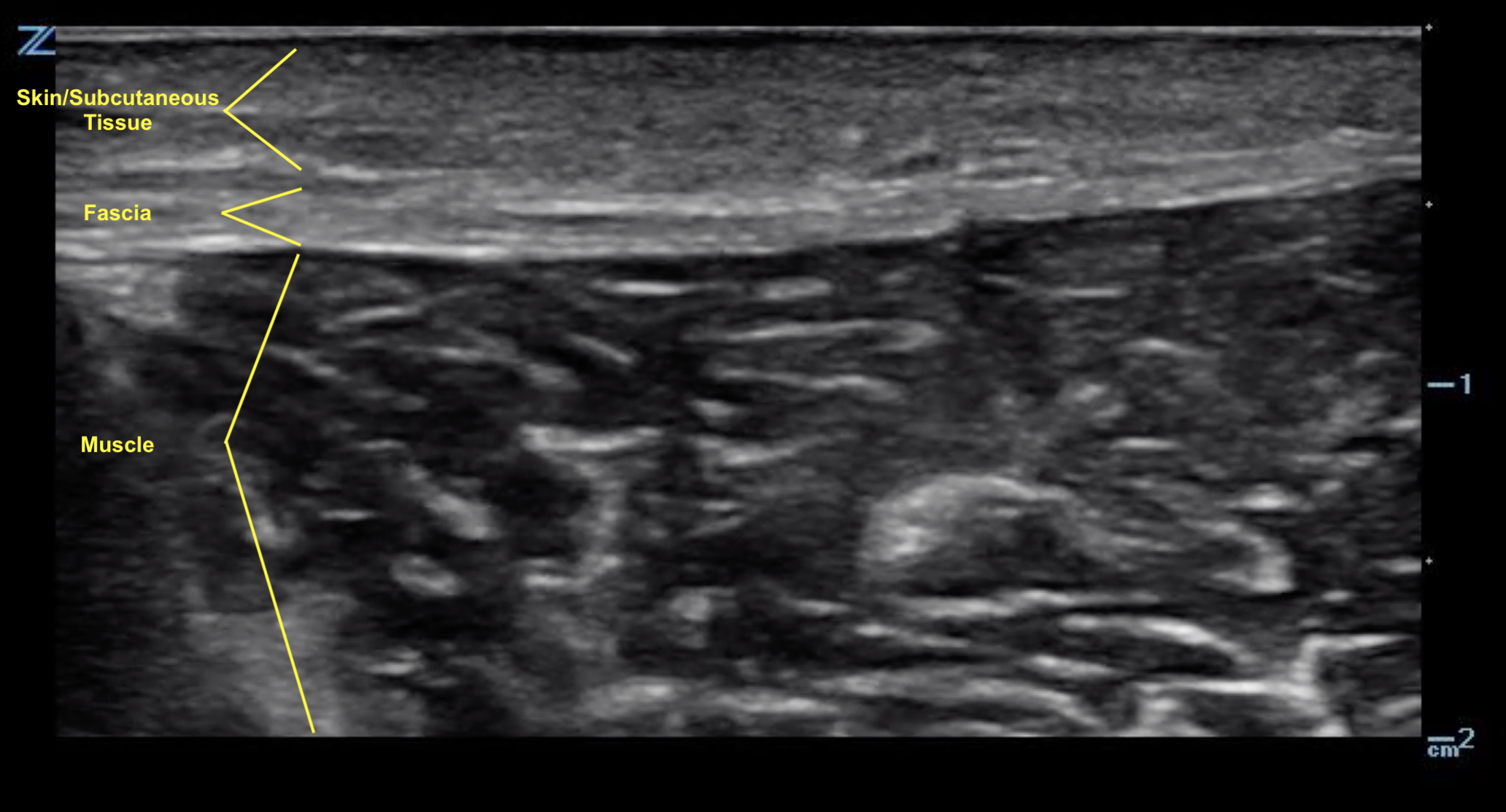 Sonoguide // Abscess Evaluation