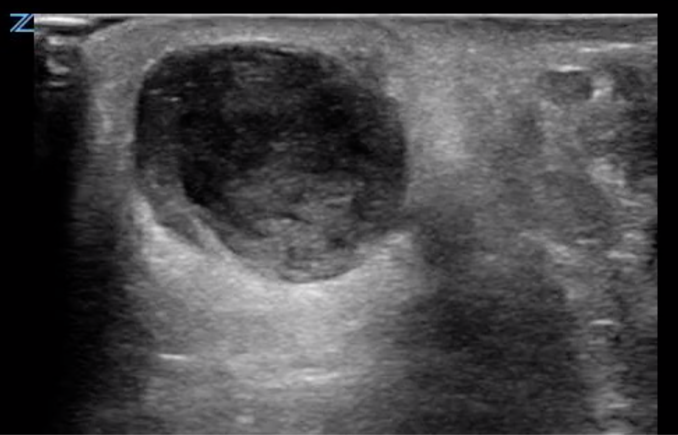 sonoguide-abscess-evaluation