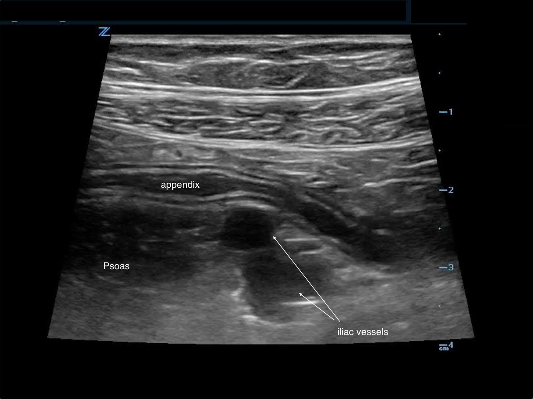 Em Ultrasound Section How To Diagnose Appendicitis In A Child