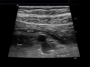 EM Ultrasound Section How To Diagnose Appendicitis In A Child