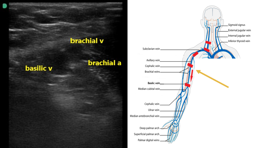Brachial Vein Ultrasound