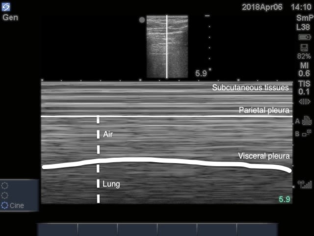 Sonoguide // Lung