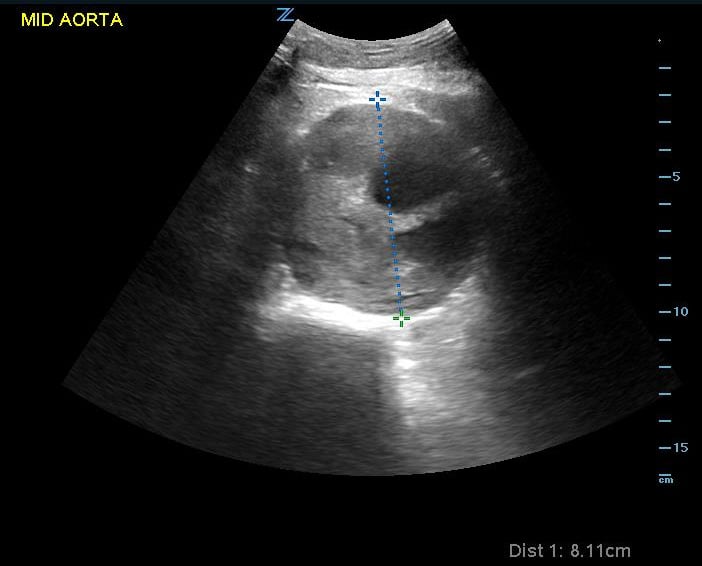 Sonoguide // Rapid Ultrasound for Shock and Hypotension (RUSH)