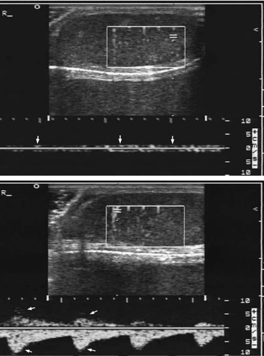 EM Ultrasound Section // Cases That Count: Whirlpool Sign in Testicular ...