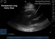 Aorta Ultrasound Measurements