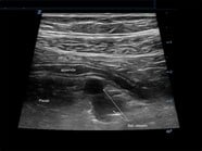 How To Diagnose Appendicitis In A Child EM Ultrasound Section