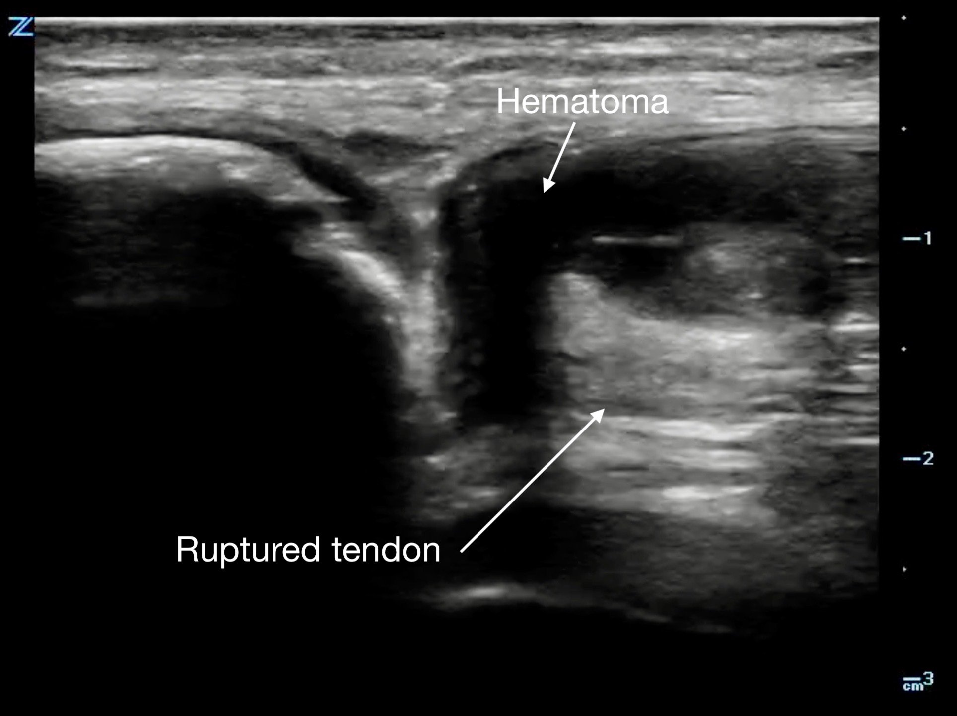 MSK-Figure 13b - Complete rupture.jpeg