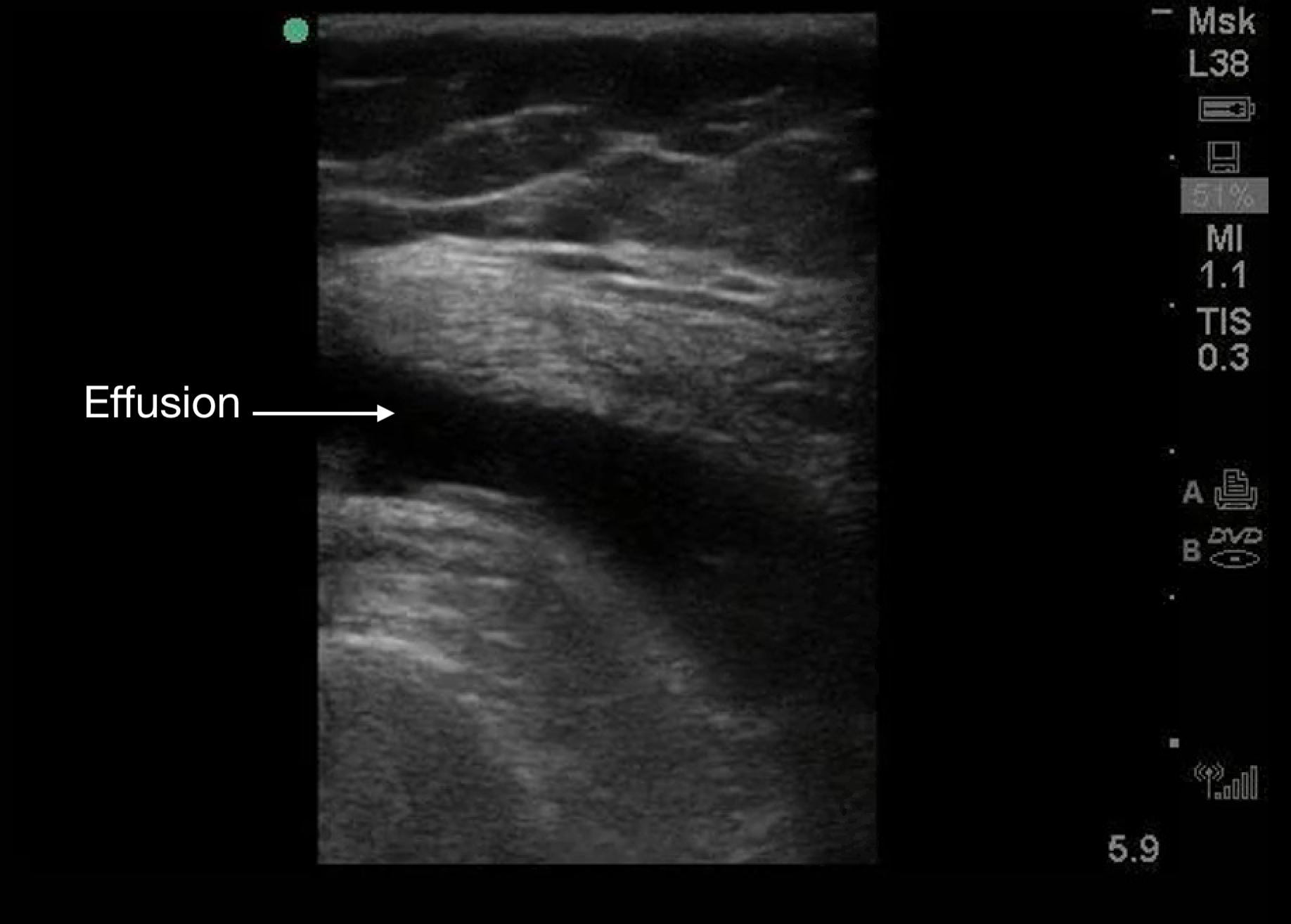 MSK-Figure 8 - Knee effusion.png