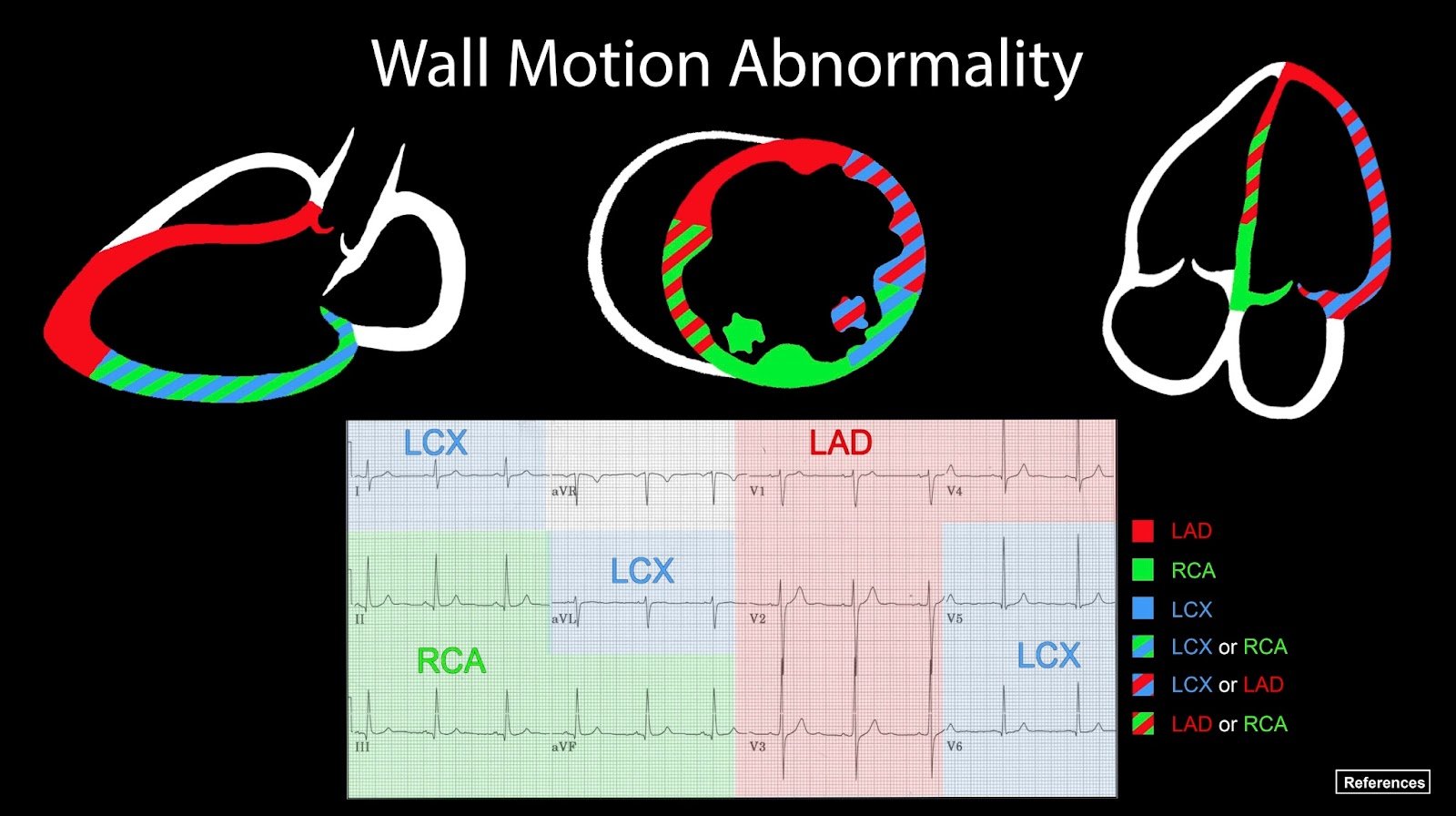 Advanced Echo Pocket Card Series: Regional Wall Motion Abnormality | EM ...