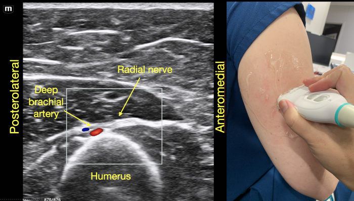 RadialNerve-Image1 Aug2024.png