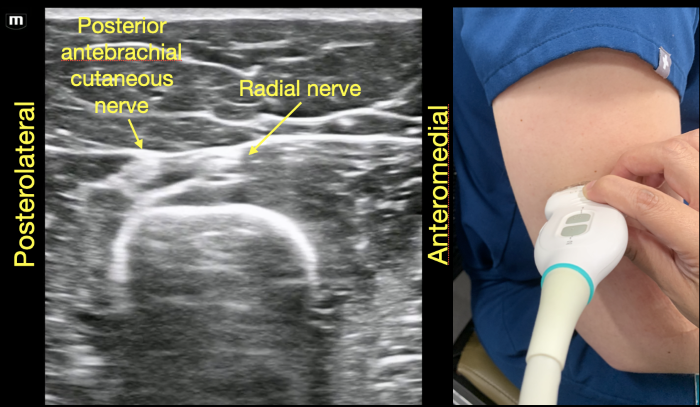 RadialNerve-Image4 Aug2024.png