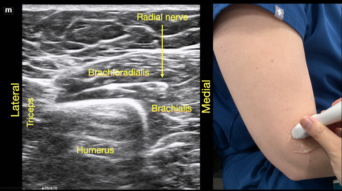 RadialNerve-Image5 Aug2024.png