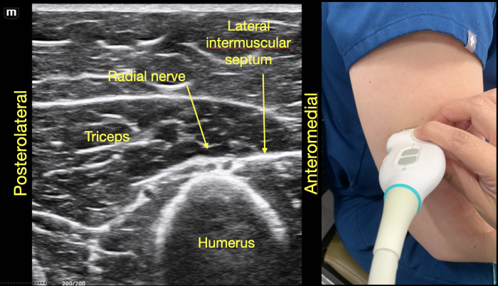 RadialNerve-Image6 Aug2024.png