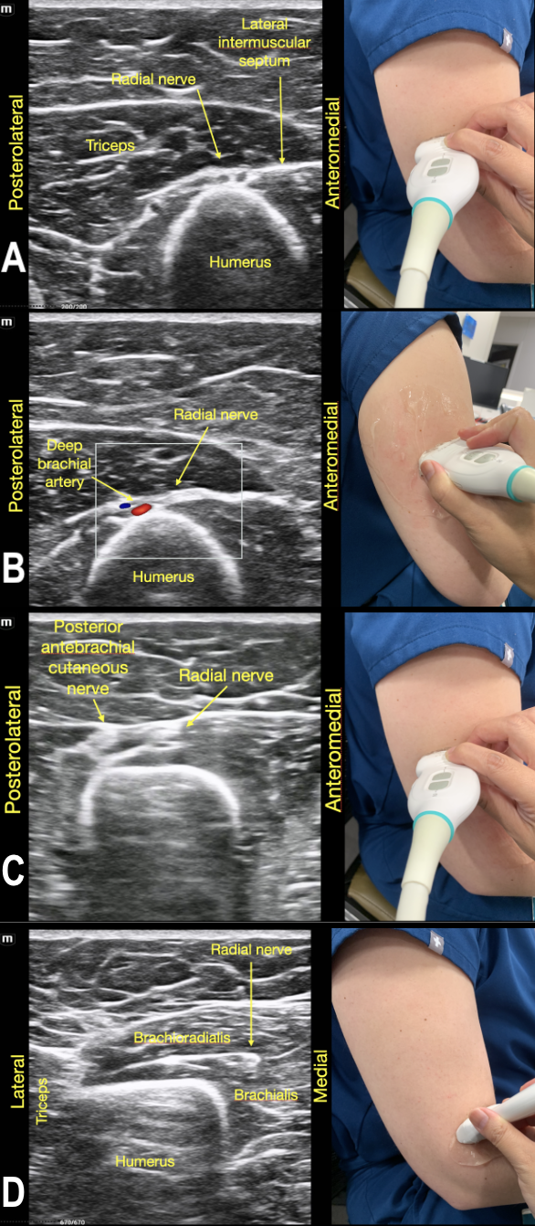 RadialNerve-Image7 Aug2024.png