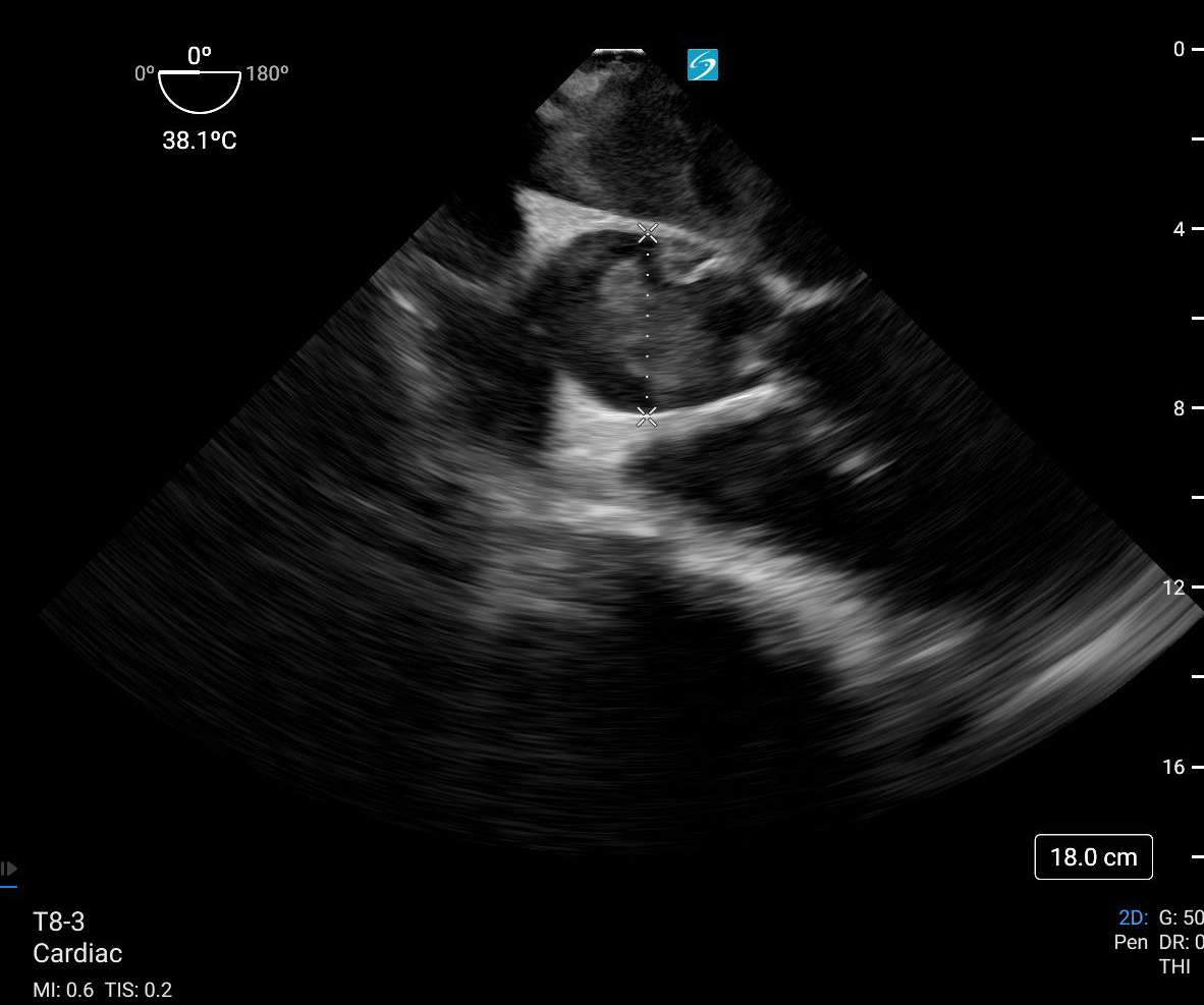 Aortic Dissection Still Measurement.png